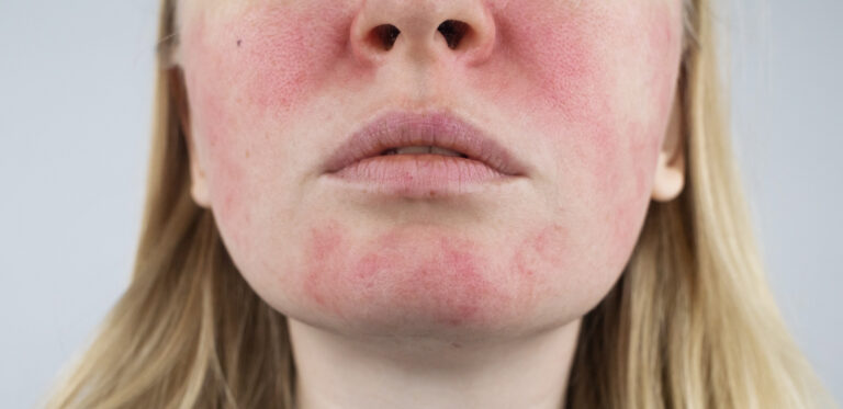 Rosacea face. The girl suffers from redness on her cheeks. Coupe